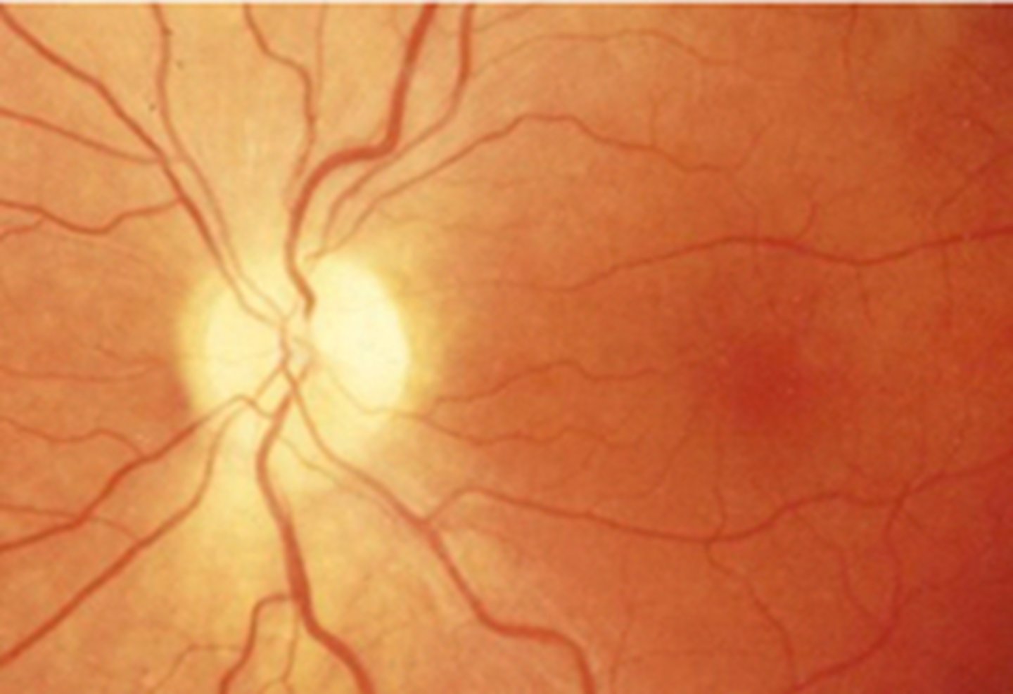 <p>ONH hypoplasia</p><p>myopia</p><p>aphakia</p><p>optic atrophy</p><p>infants</p>