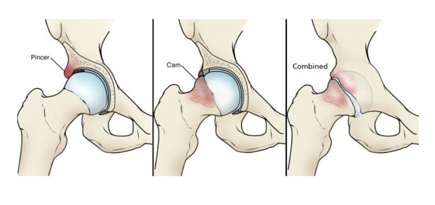 <ul><li><p>Pincer:</p><ul><li><p>Extra bone on the acetabulum</p></li></ul></li><li><p>Cam</p><ul><li><p>Extra bone on the femoral head </p></li></ul></li><li><p>Combined</p><ul><li><p>Both cam and pincer are present </p></li></ul></li></ul><p></p>