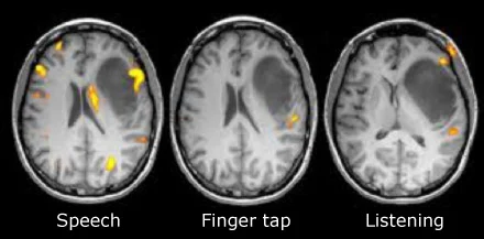 <p><strong>Functional Magnetic Resonance Imaging</strong></p><p>Uses a magnetic field (like an MRI) to create an image, but also measures blood-oxygen (haemodynamic) levels for brain activity</p><ul><li><p>Brain areas with low blood oxygen (BOLD — <em>blood-oxygen</em> signal) are presumed to be more active</p><ul><li><p>Works because the magnetic resonance signal of blood depends on the level of oxygen (More brain activity → More O<sub>2</sub> consumption)</p></li></ul></li><li><p>Doctors ask patients to do something (e.g. opening and closing their hand) while inside the MRI machine to reveal how the brain does tasks</p></li><li><p>Shows FUNCTION and STRUCTURE of the brain</p></li></ul><p></p>