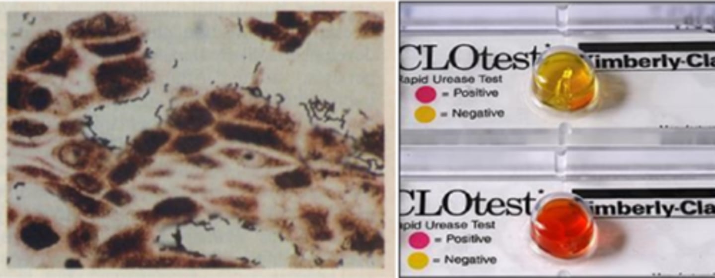 <p>-Screening: serology (IgG)</p><p>-Diagnosis: surgical pathology, CLO test, urea breath test</p><p>-Test of cure: stool antigen test, urea breath test</p><p>-Mega urease-producer (CLO test hot pink)</p><p>-can cause gastritis, peptic ulcer disease, gastric cancer, and gastric MALT lymphoma which can be treated with antibiotics</p>