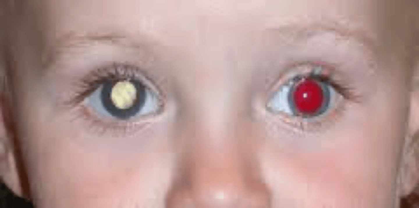 <p>Normal REDDISH coloration of the PUPILS that is visible when LIGHT SHINED into the pupil reflects off the inside surface of the eye. Conditions that may cause absent or abnormal results in a newborn include cataracts, retinal abnormalities, refractive errors, and strabismus.</p>