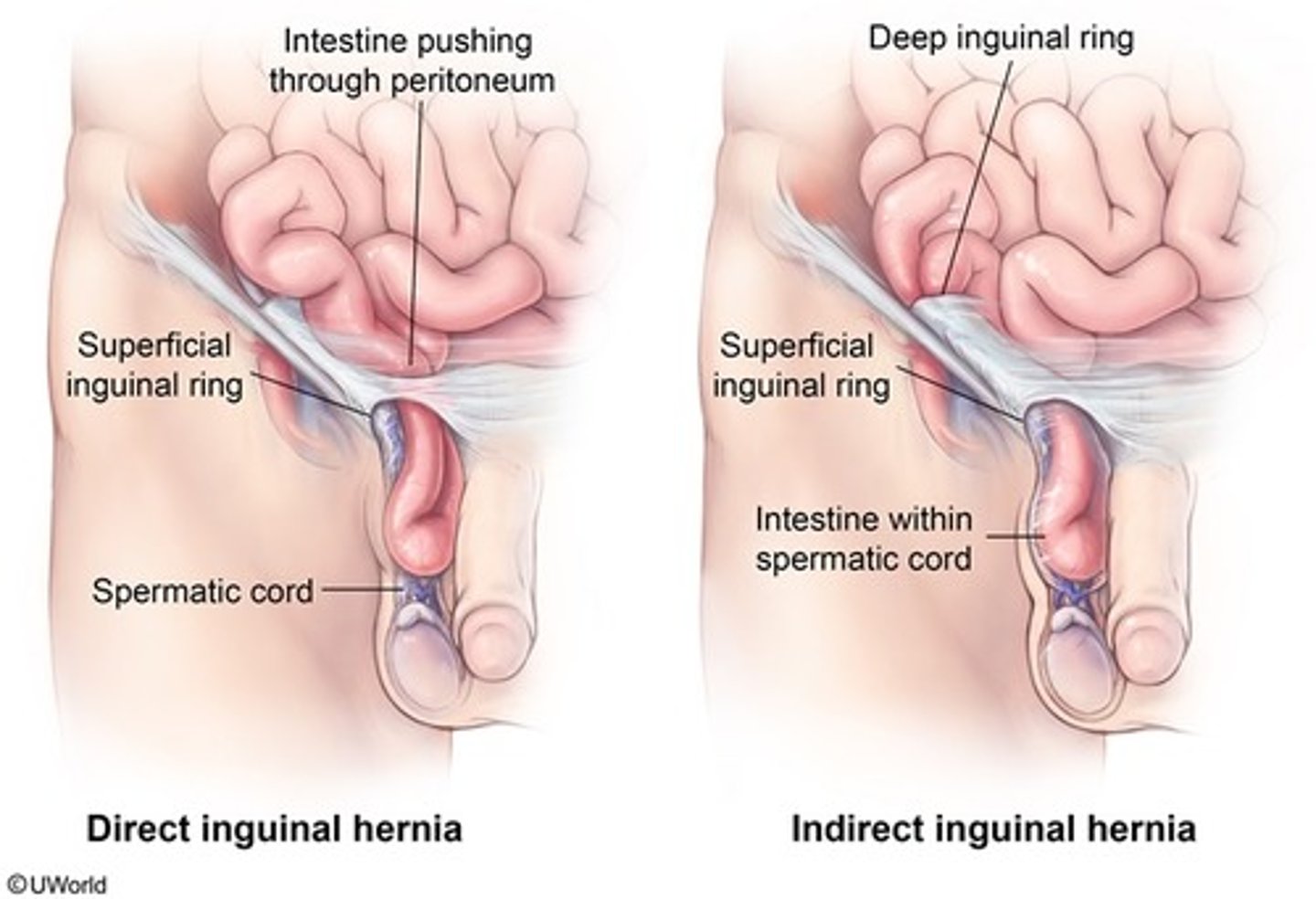 <p>Indirect: herniation of abdominal contents through deep inguinal ring &amp; down inguinal canal (MC in kids)</p><p>Direct: herniation of abdominal contents through floor of inguinal canal</p>