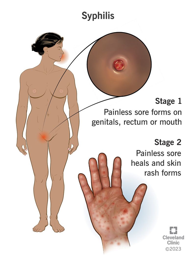 <p>PP: skin/mucous membranes→circulatory system (tertiary/late)→CNS (neurosyphillis)</p><p>E: trepodema pallidium<br>sexual contact<br>congenital</p><p>CM:<br><u>primary:</u><br>painless/indurated macule/papule<br>highly infectious<br>heals in 3-6 weeks</p><p><u>secondary:</u><br>several weeks after primary syphillis<br>persists for weeks-months<br>highly infectious<br>rough/red/non-itching papules/patches on <strong>trunk+palms+soles</strong></p><p><u>latent:</u><br>asx<br>only shows with positive serologic test</p><p><u>tertiary/late:</u><br>widespread abx→rare<br>gummatous lesions<br>CV sx</p><p><u>neurosyphillis:</u><br>asx<br>or<br>acute syphilit meningitis<br>ocular involvement</p><p><u>congenital:</u><br>deafness<br>deformities<br>neuro impairment</p><p>DX: treponemal qualitative+nontreponemal qualitative<br>HIV testing<br>report to state department</p><p>TX: IM penicillin<br>doxycycline<br>tetracycline</p><p>C:<br>congenital:<br>stillbirth<br>neonatal death<br>infant disorders</p>