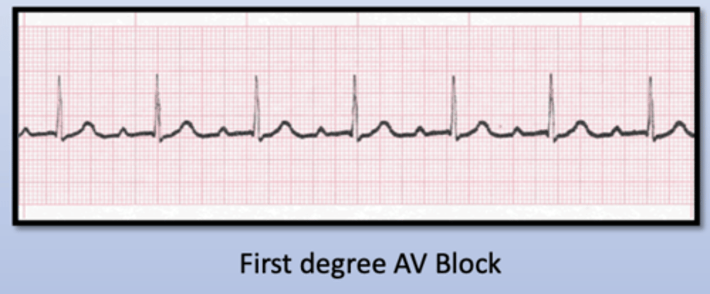 <p>_____ is defined as a heart rate below 60 beats and comprises multiple disorders</p><p>- Sinus bradycardia</p><p>- First degree AV Block</p><p>- Second Degree AV Block</p><p>- Third Degree AV Block</p><p>- SA Node Exit Block</p>