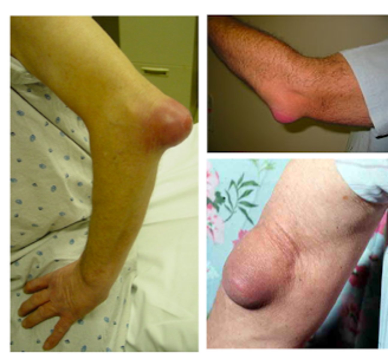 <p>olecranon bursitis</p>