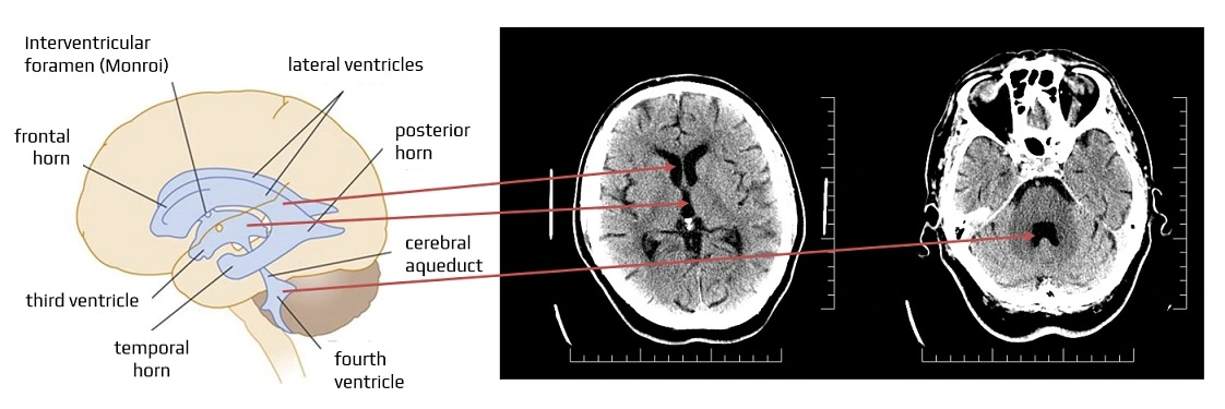 <p>What connects the lateral ventricles to the 3rd ventricle?</p>