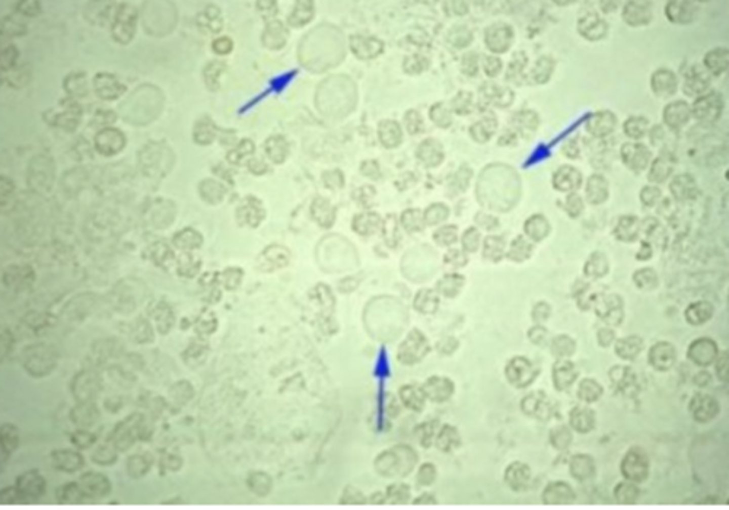 <p>Trichomonas vaginalis, Enterobius vermicularis, and Schistosoma haematobium. Parasites and parasitic ova are usually present in urine sediment due to vaginal or fecal contamination.</p>
