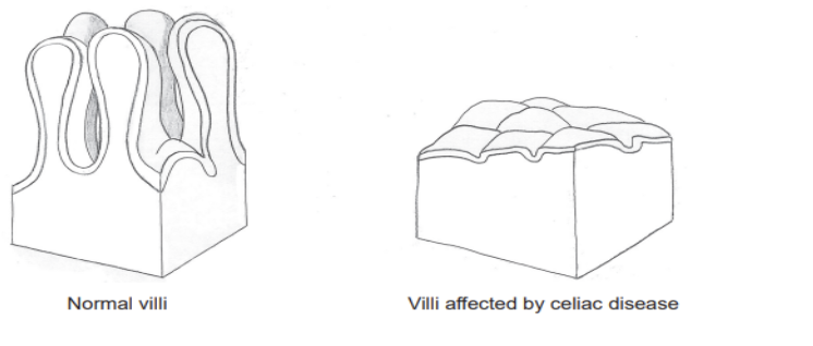 <p><span style="background-color: transparent;"><span>&nbsp;&nbsp; Celiac disease is an immune reaction to eating gluten, a protein found in many cereals. The diagram shows the arrangement of normal villi and villi affected by celiac disease in the small intestine.</span></span></p><p></p><p><span style="background-color: transparent;"><span>(b) Explain the consequences of celiac disease for absorption of digested nutrients. [2]</span></span></p>