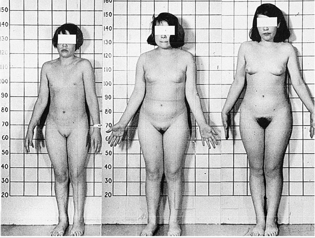 <p>Fig. 11. 24: Psychosocial dwarfism</p>