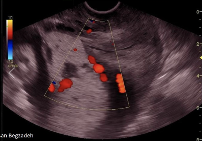 <p>a pt has 33w gestation w/<strong>recent onset </strong>intermittent bleeding that is bright red. she does <strong>not</strong> have any associated <strong>pain or cramping</strong></p><p>.</p><p>a) placenta previa</p><p>b) placental abruption</p><p>c) premature rupture of membranes</p><p>d) placenta accreta</p>