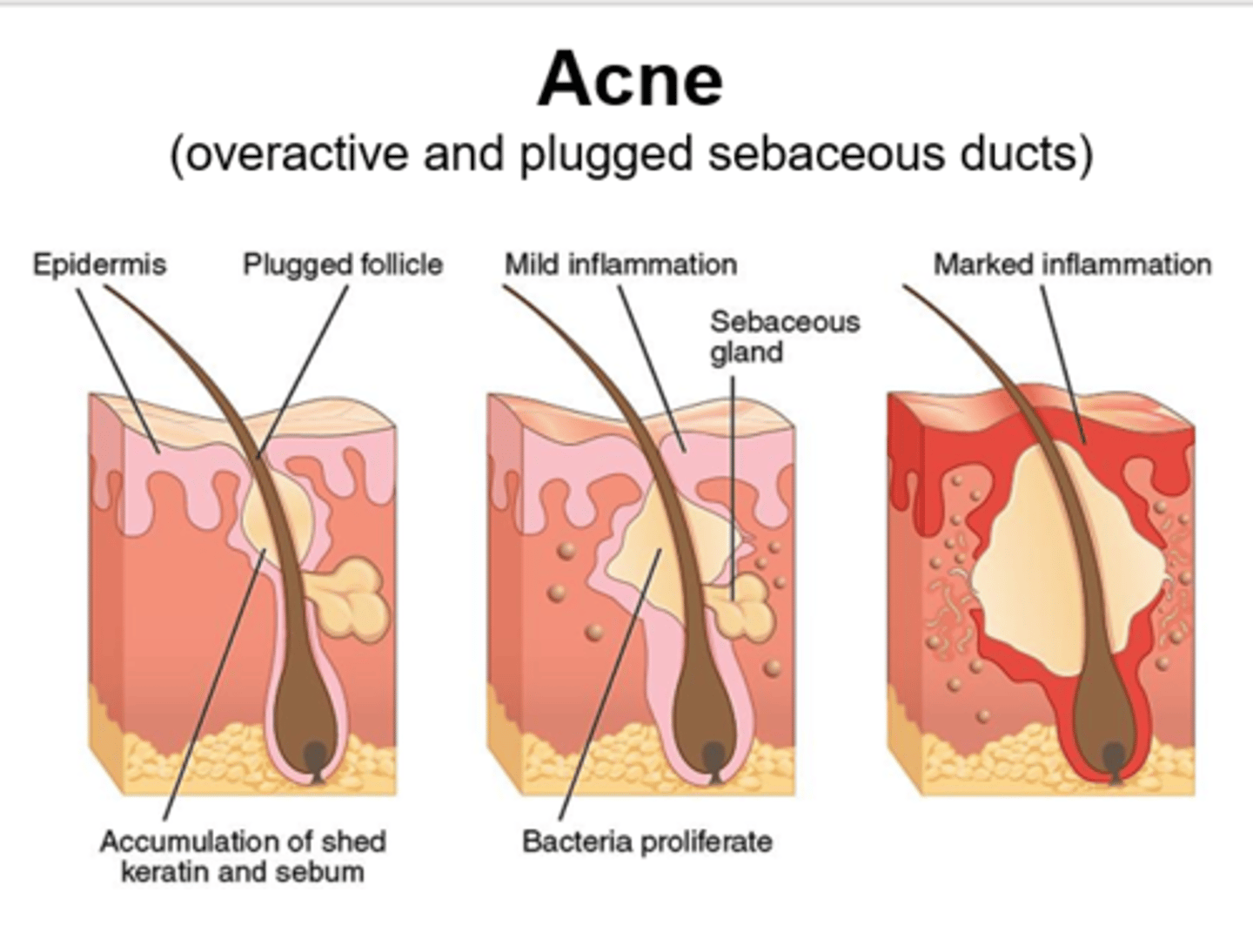 <p>1. Excess skin (plugged follicles)</p><p>2. Excess oil (inc. sebum)</p><p>3. Bacteria (cutibacterium)</p><p>4. Inflammation (rupture of follicle)</p>