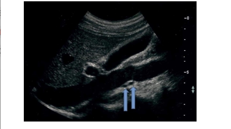 <p>what is the most common [1/3] normal variant in renal artery anatomy </p><p>.</p><p>a) duplicated renal arteries</p><p>b) no left renal artery</p><p>c) right renal artery courses anterior into IVC</p><p>d) no right renal artery</p>