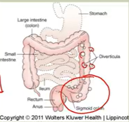 <p>Herniation outpouchings of mucosa/submucosa layers; sigmoid colon</p><ul><li><p>Asymptomatic</p></li><li><p>^ in pts w/v fiber diet & uncs</p></li></ul><p></p>