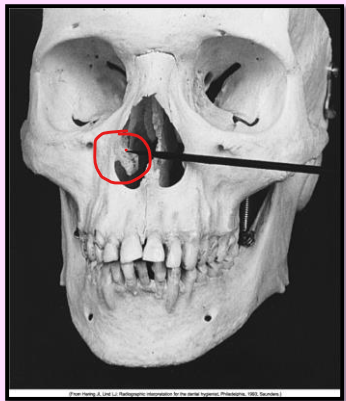 <p>Inferior nasal conchae </p><ul><li><p>wafer-thin, curved plates of bone that extend from the lateral walls of the nasal cavity </p></li><li><p>Radiography: diffuse <strong>radiopaque </strong>mass of projection within the nasal cavity Z</p></li></ul><p></p>