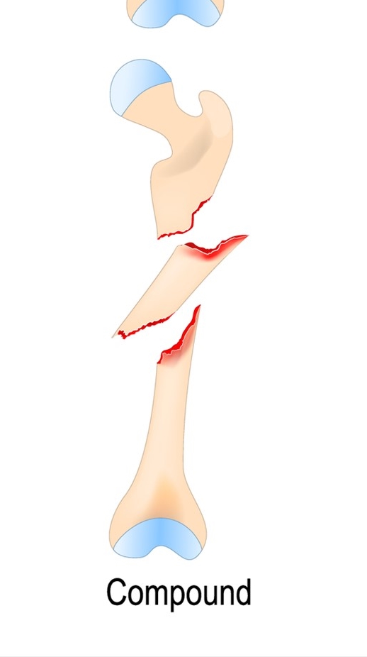 <p>compound fracture</p>