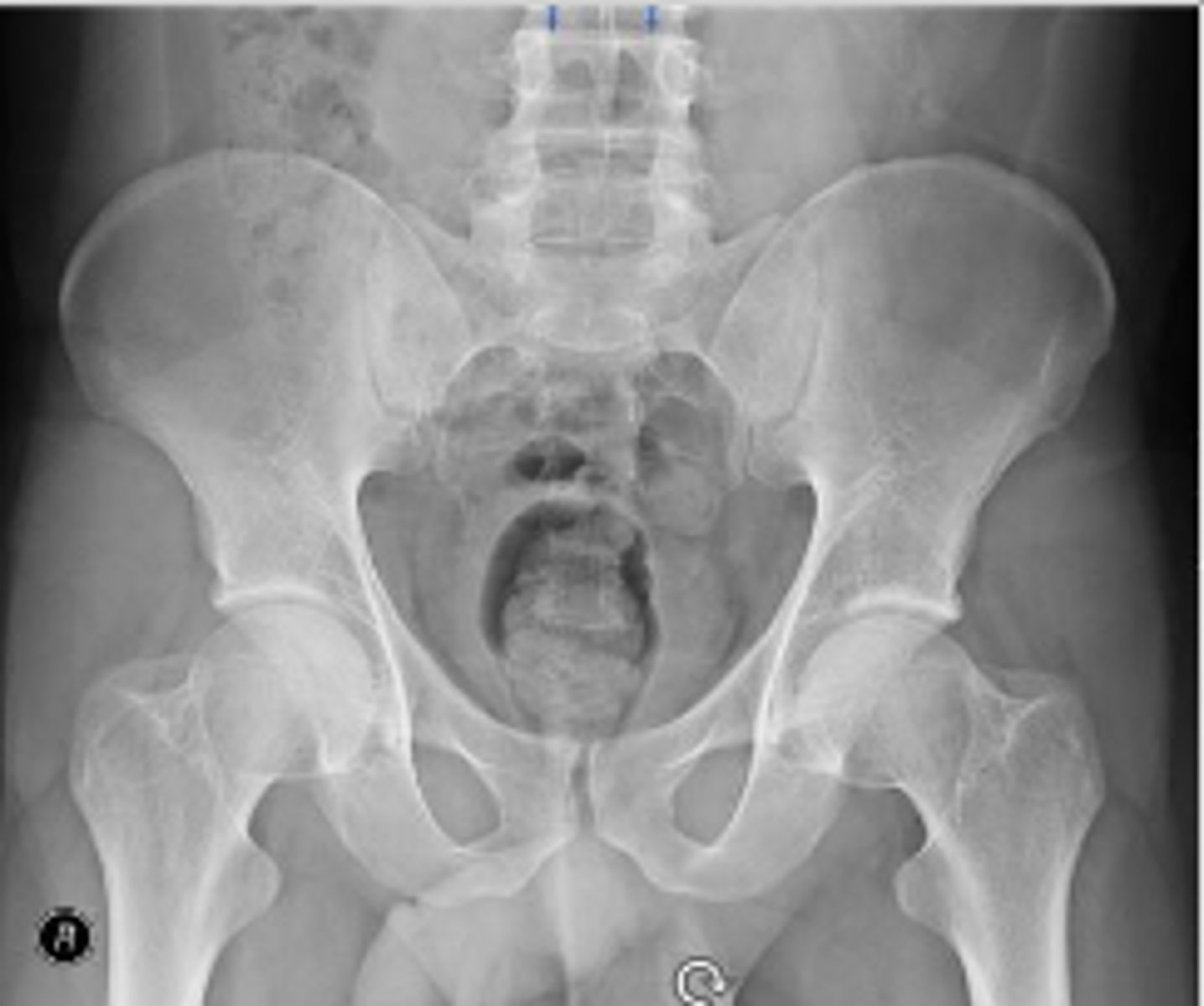 <p>What IVD space is indicated by the arrows?</p>