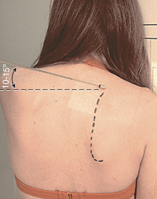 <p>Neer method&nbsp;</p><ul><li><p><span><span>10° - 15° caudal angle (towards feet)</span></span></p></li><li><p><span><span>Patient is positioned same as PA Scapular “Y”</span></span></p></li></ul><p></p>
