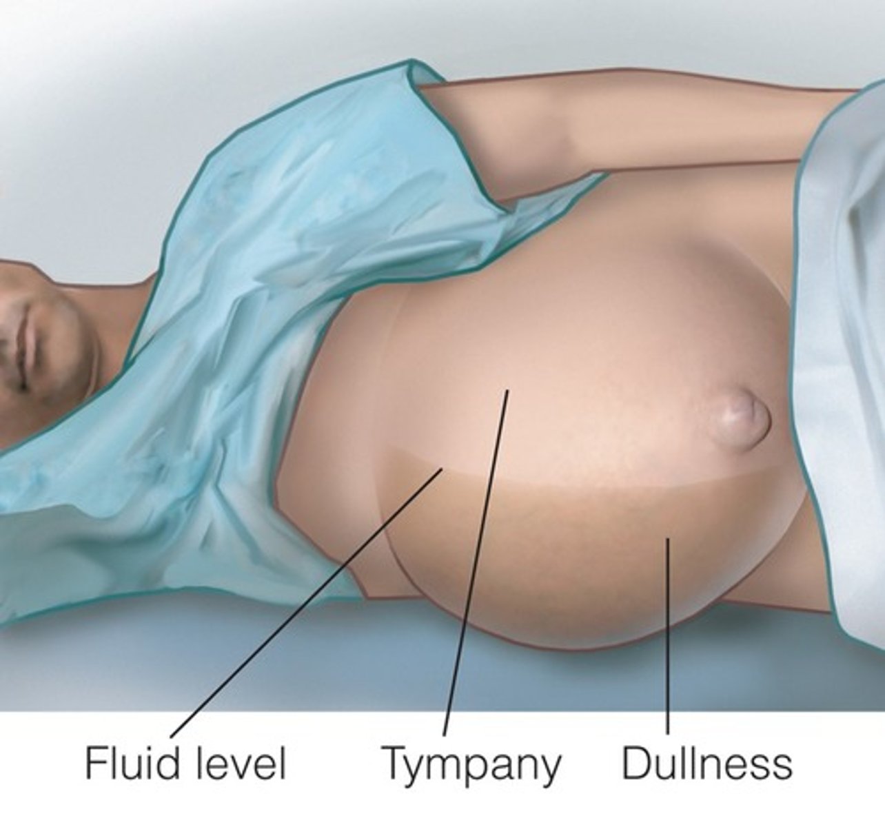 <p>build up of fluid in abdomen</p>