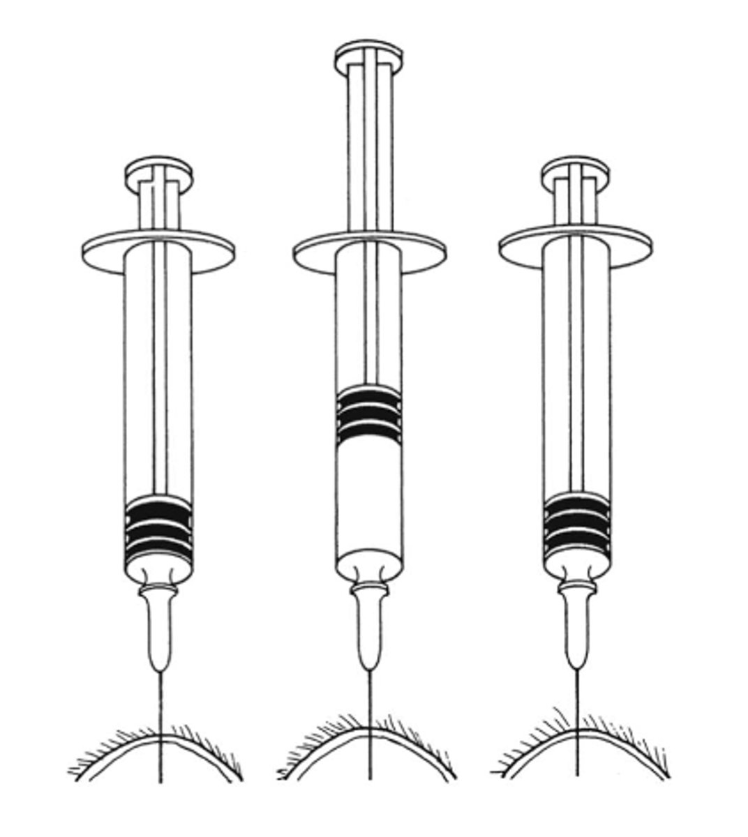 <p>What fine needle aspirate technique is this?</p>