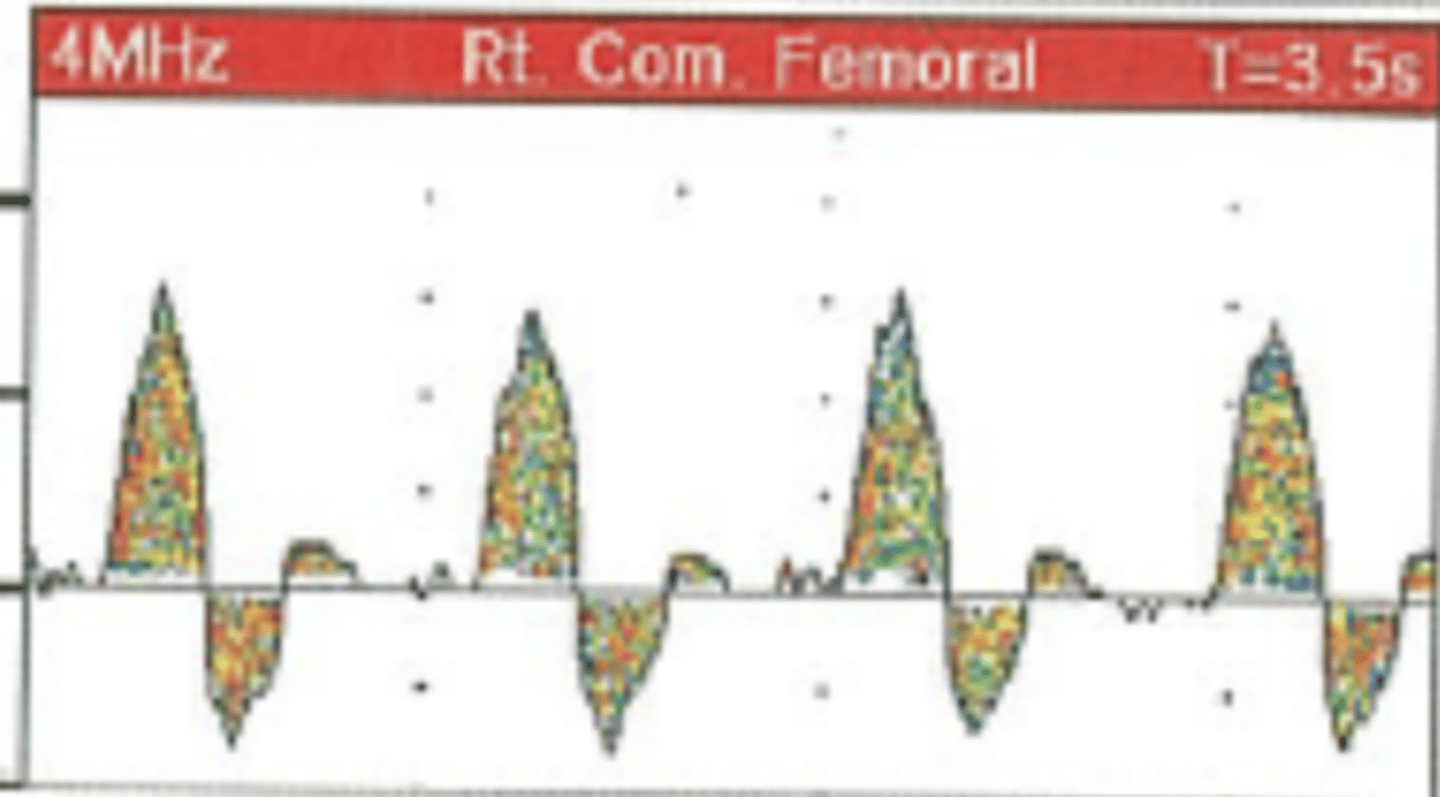 <p>2 phases</p><p>2 forward antegrade beats</p><p>Normal</p>