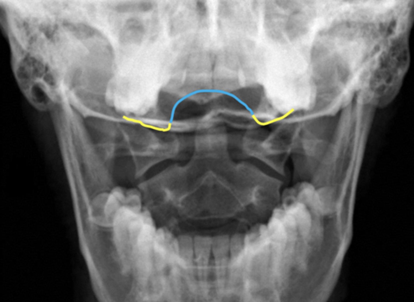 <p>What are outlined in yellow?</p>