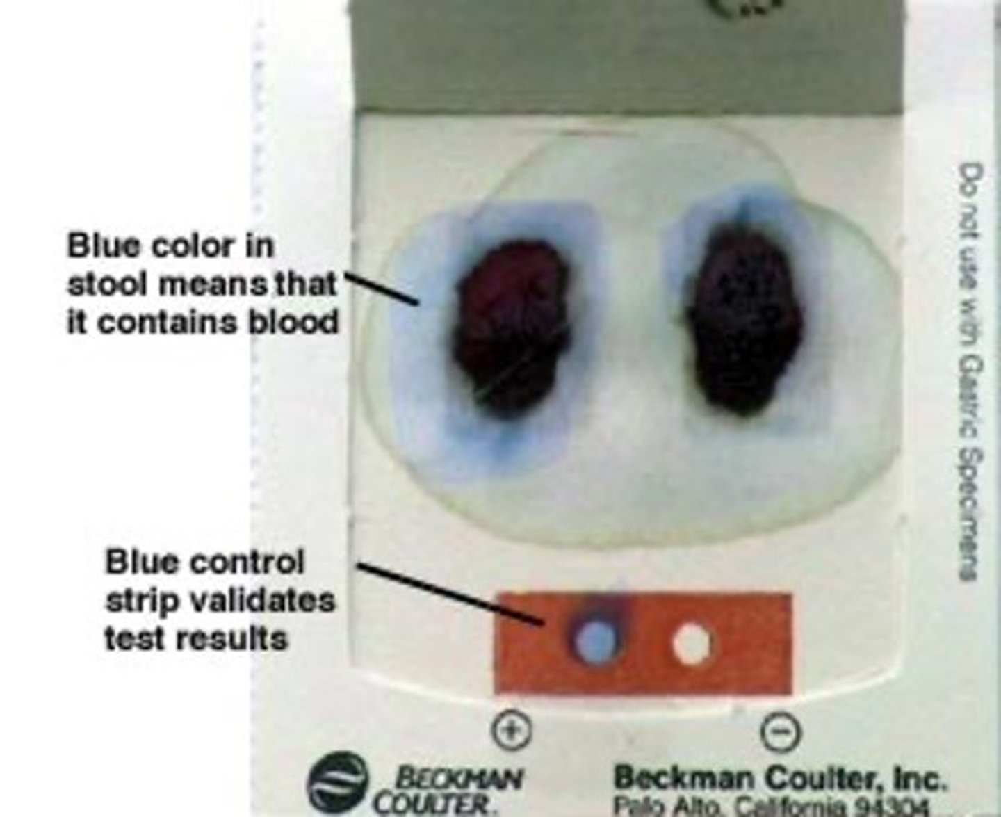 <p>- blood that is only detected by microscopic examination</p><p>- fecal occult blood test looks for blood in feces</p>