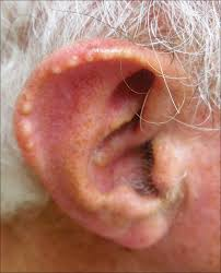 <p>chronic rheumatoid arthritis</p><p>may be present before arhtritis</p><p>small lumps on helix/antihelix+hands</p><p>repeated injuries→ulcerations</p>