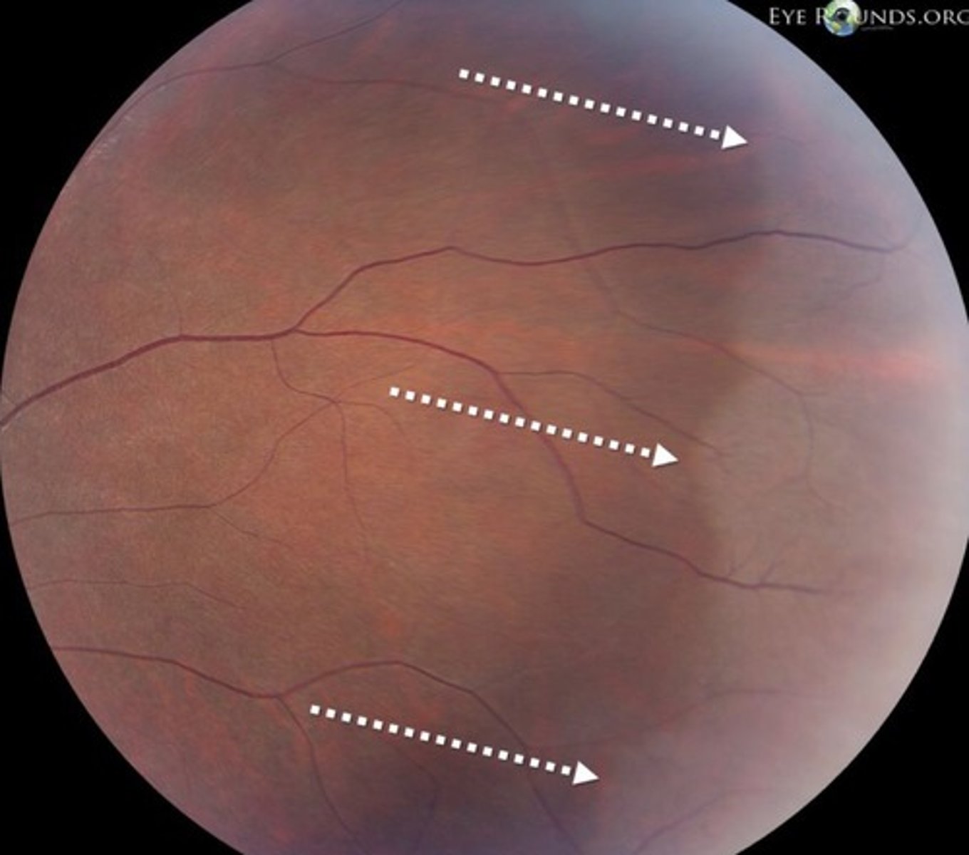 <p>Asymptomatic</p><p>•White-grey appearance of the equator and/or peripheral retina</p><p>•Well demarcated scalloped borders</p><p>•Seen without scleral indentation (CF: white with pressure)</p><p>•Occurs in about 30% of all patients</p><p>• More common in patients with dark skin</p><p>•Usually bilateral</p><p>•Benign</p>