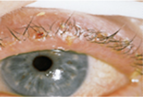<p>Inflammation of the eyelids. Caused by infection or dermatitis. </p>