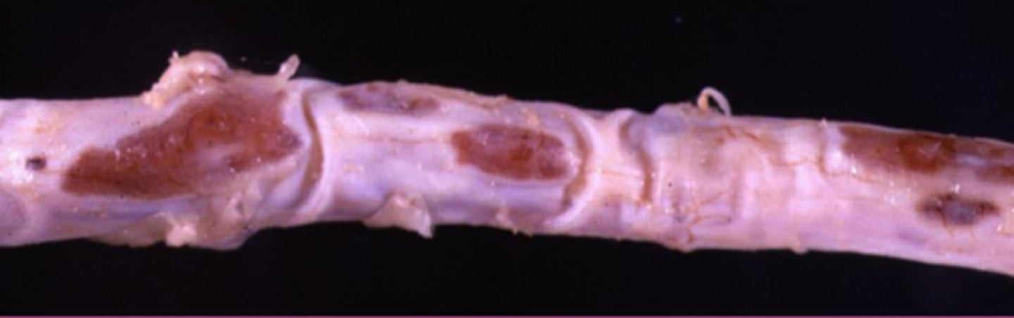 <p>What is this extracellular inclusion of the dura mater?</p>