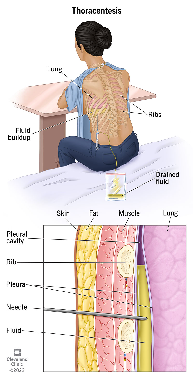 <p>(Pleural Puncture)</p><ul><li><p class=""><strong>Purpose</strong>: Diagnostic or therapeutic aspiration of pleural fluid.</p></li><li><p class=""><strong>Position</strong>: Patient seated, leaning forward.</p></li><li><p class=""><strong>Site</strong>: 8th–9th intercostal space</p><ul><li><p class="">mid/posterior axillary line.</p></li></ul></li><li><p class=""><strong>Technique</strong>:</p><ul><li><p class="">Local anesthesia (1%)</p></li><li><p class="">Needle inserted <strong>above upper border of rib below</strong> (to avoid neurovascular bundle)</p></li><li><p class="">Antibiotic instillation post-aspiration</p></li></ul></li></ul><p></p>