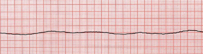<p>Asystole in which there is a sudden cardiac arrest and blood flow to organs stops - ROSC less likely to be achieved OHCA</p>
