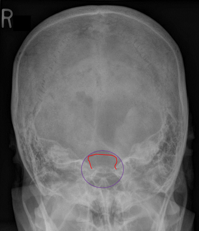 <ul><li><p>BTP: dorsum sellae and clinoids visualized in the foramen magnum</p><ul><li><p>excessive = SI of the posterior arch of C1 over dorsum sellae</p></li><li><p>insufficient = dorsum sellae seen superior to the foramen magnum&nbsp;</p></li></ul></li><li><p>Tilt: nasal septum and sagittal suture // LA, petrous ridges // SA</p></li><li><p>Rotation: dorsum sellae equidistant to the lateral borders of the foramen magnum (rotation is towards the narrowed side)</p></li></ul><p></p>