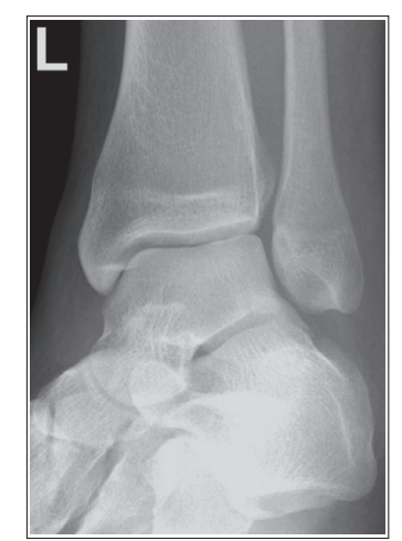 <p>What are the issues with this mortise ankle? </p>