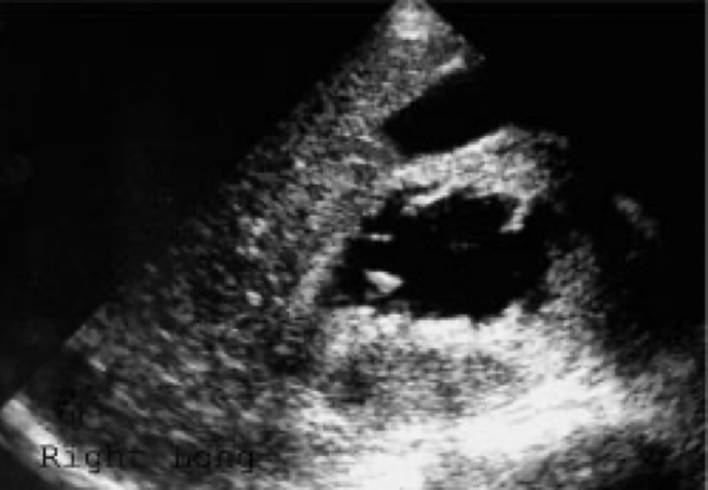 <p>-large mass in renal pelvis</p><p>-obstruction from kidney stones may be present</p>