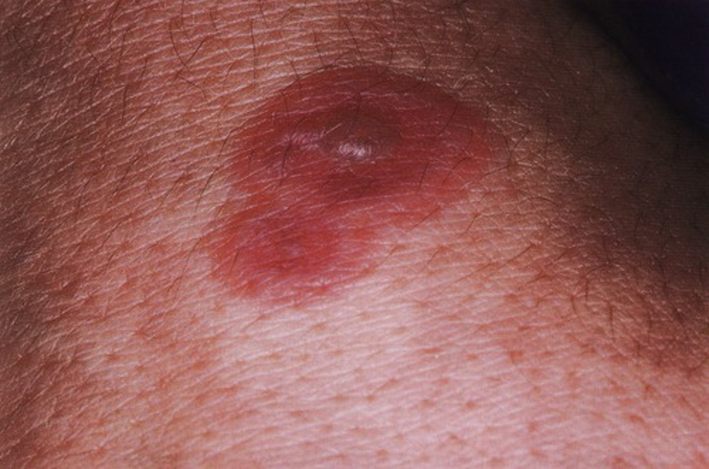<p>Erythema (exsudativum) mulitforme: Kokarde, ein aus zwei, manchmal drei konzentrischen Ringen bestehendes Erythem, welches im Verlauf blasenförmig werden kann. Ca. 3 cm im Durchmesser mit gerötetem Rand und Umgeben von einer helleren Zone, welche sich von der zentralen Blase abgrenzt. Es tritt bevorzugt an den Extremitäten auf und wird nach heutigem Kenntnisstand durch das Herpes simplex Virus ausgelöst. Die Krankheitsdauer beträgt 1-2 Wochen. Das Erythem kann - wie in unserem Fall - rezidivierend auftreten.</p>