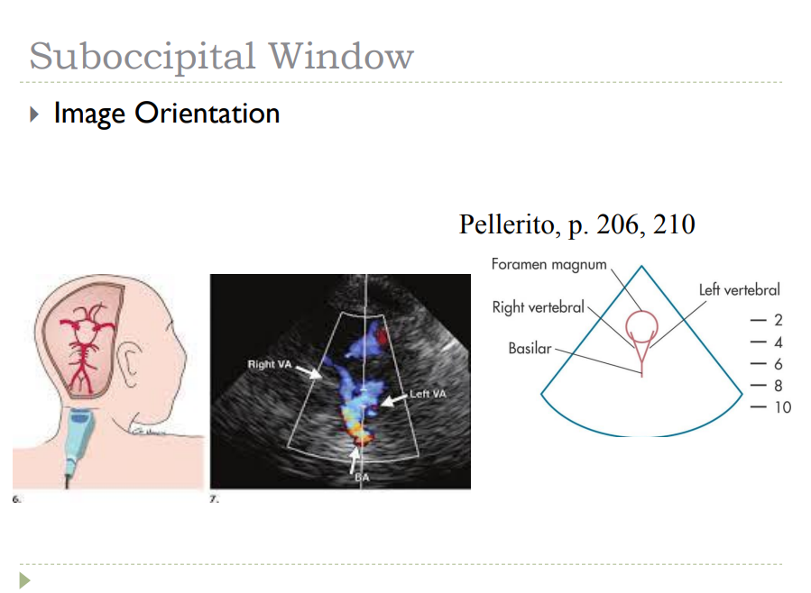 <ol><li><p>Foramen magnum- large circular anechoic area  </p></li><li><p>Occipital bone- bright echogenic reflection </p></li><li><p> Right vertebral- left side of image </p></li><li><p> Left vertebral- right side of image </p></li><li><p> Basilar artery- deep to vertebrals</p></li></ol><p></p>