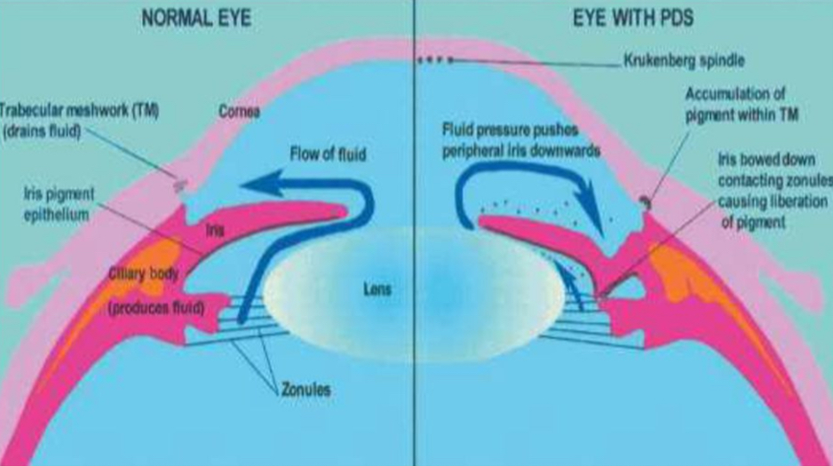 <p>Aqueous moves from posterior to anterior chamber. Pigment blocks the TM, causing pressure to increase anteriorly. This pushes the iris backwards, causing the zonules to against the lens.</p>