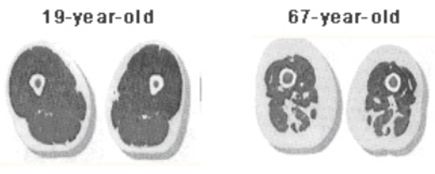 <p>-irreversible muscle atrophy with age (starts around 30-40); why athletic performance decreases</p><p>-muscle fibers die and get replaced w/ non-contractile connective tissue (less crossbrdige formations)</p><p>-sarcopenia delayed w/ exercise</p>