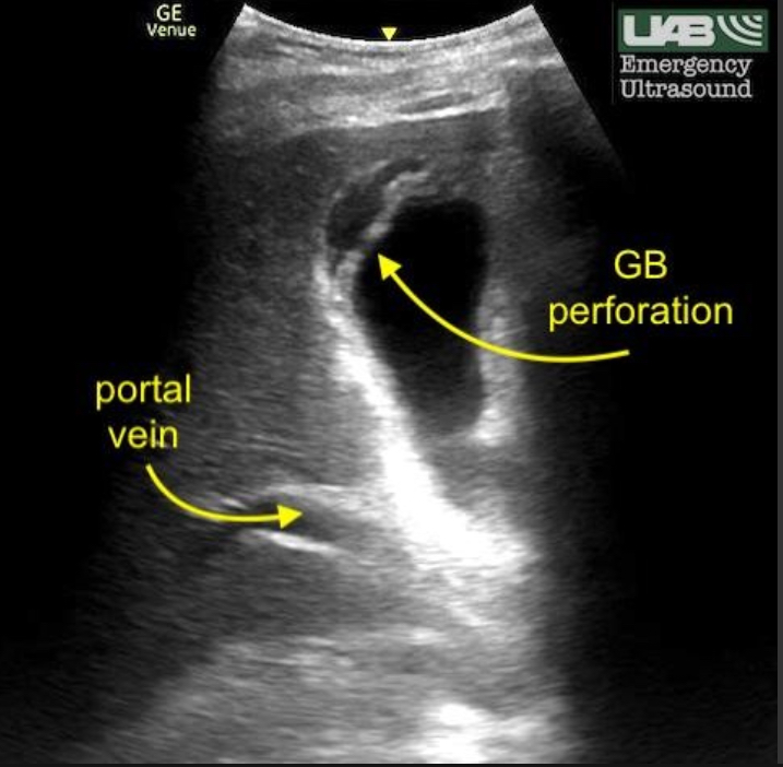 <p>W<span>all rupture due to untreated acute cholecystitis </span></p><p><span>Wall defect, adjacent abscess/fluid, complex pericholecystic area, possible stones/debris outside GB</span></p>