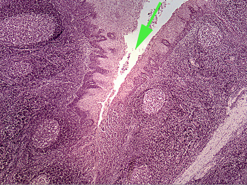 <p><span>The green arrow is indicating a tonsilar <strong>crypt</strong></span></p>