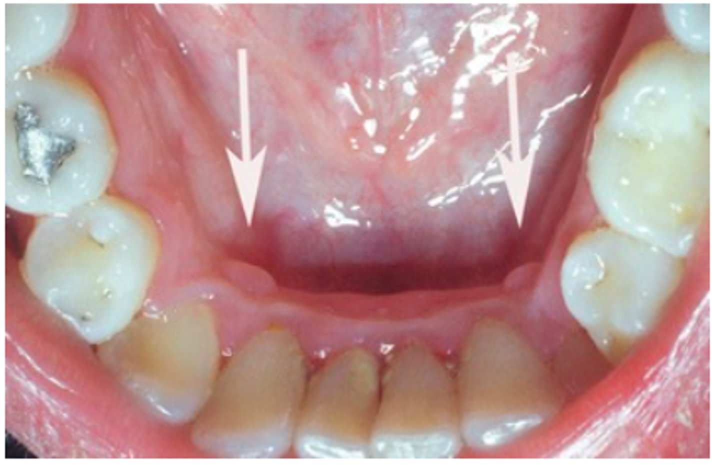 <p>• Papillary-like growth</p><p>• Mandibular gingiva lingual to</p><p>canine</p><p>• Frequently bilateral</p><p>• 25-99% of children/YA</p><p>• Involutes with age</p><p>• Should be recognized clinically</p><p>as a normal anatomic variation</p>