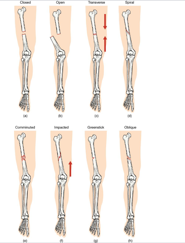 <p>Joints and bones work together</p><p>When bones are stressed beyond capacity → Fractures</p><p></p>
