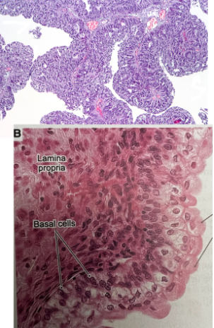 <ul><li><p>associated with <strong>transitional epithelium</strong></p></li><li><p>characterized by <strong>hematuria and papillary morphogy</strong></p><ul><li><p>low and high grade depending on cytologic features and amount of disorder present</p></li></ul></li><li><p>Cancer of the <strong>bladder</strong></p></li></ul><p></p>