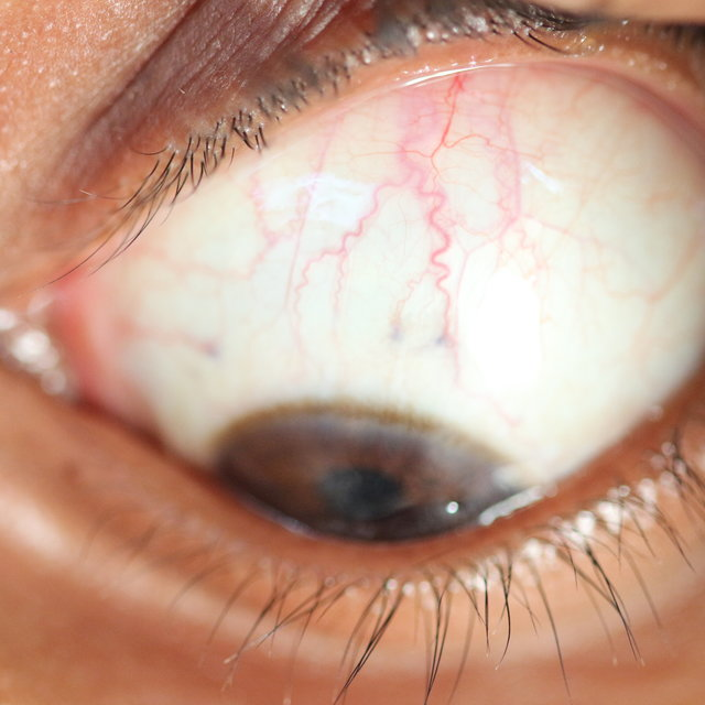 <p>Which conjunctiva is this?</p>