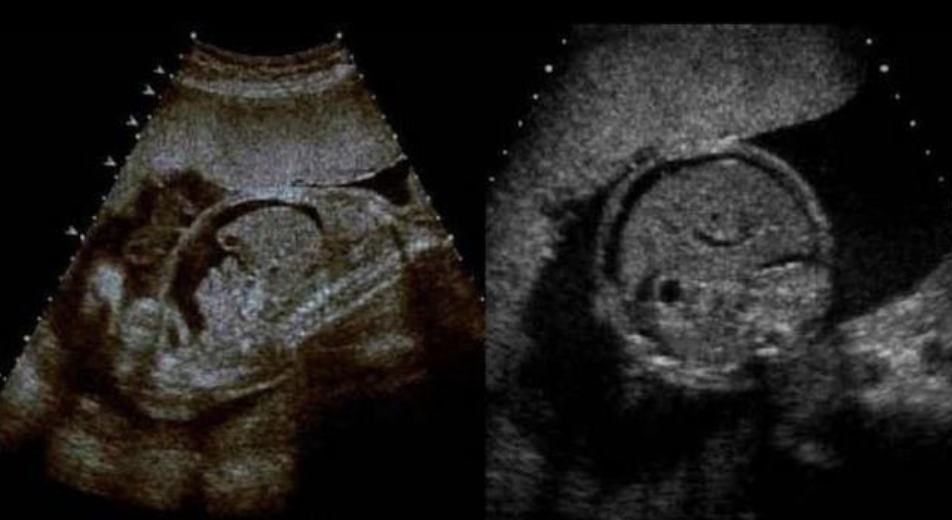 <p>a) fetal ascites + skin edema of the abd</p><p>b) fetal ascites + pleural effusions</p><p>c) skin edema of fetal abd</p><p>d) fetal ascites</p>