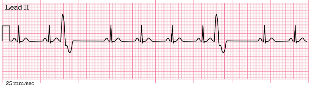 <p><span><span>The PVCs seen in the following ECG strip are which of the following type?</span></span></p>