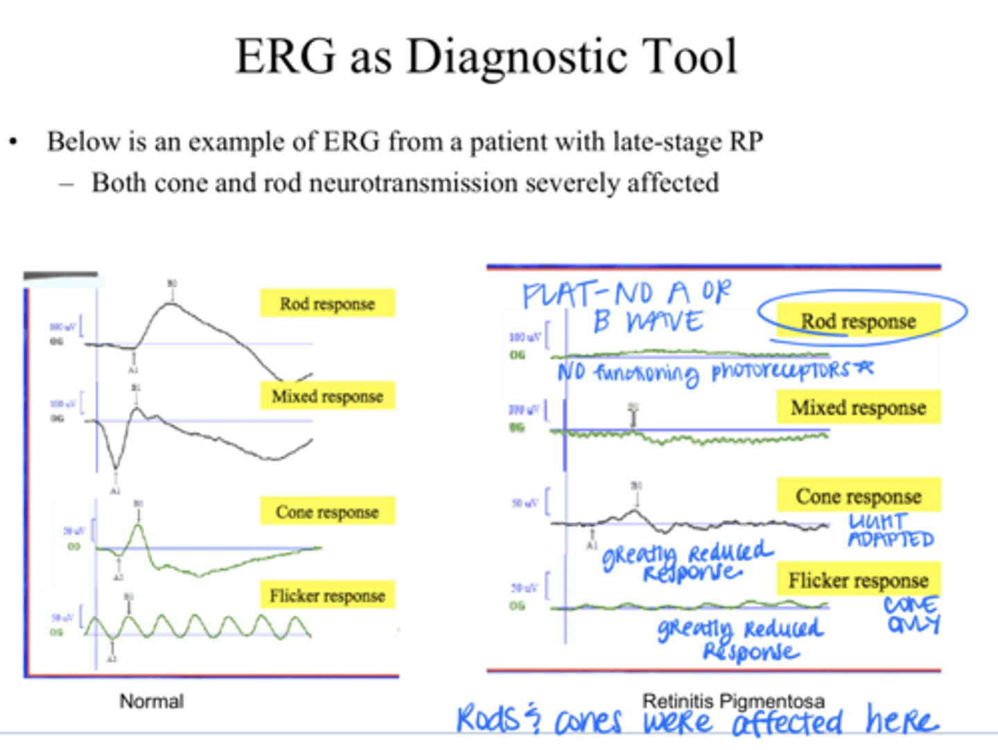 <p>As RP progresses, the lines on the ERG will ________</p>