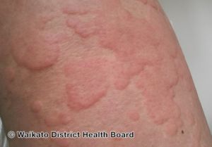 <p>A raised, irregular, transient lesion due to edema</p>
