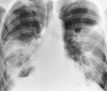 <p>multiple alveolar densities throughout lung</p>